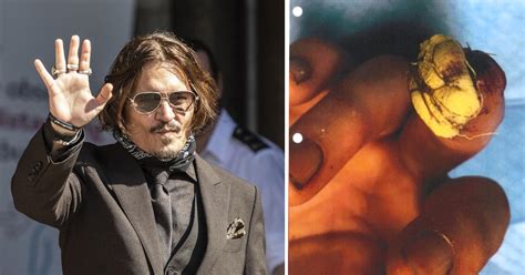 See Johnny Depp's Severed & Bloody Finger After Alleged Explosive Fight ...