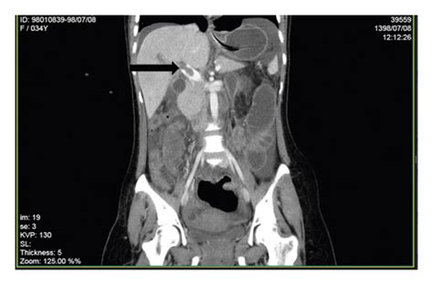 Thrombosis in main portal vein with its extension to right and left... | Download Scientific Diagram