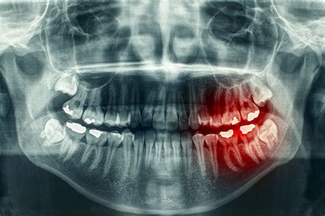 Identifying the Need for Root Canal Using Root Canal X-rays | veinscny