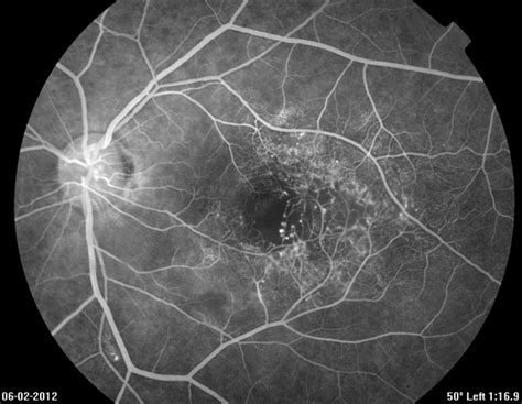 Macular Telangiectasia (FA Early Phase) - Retina Image Bank