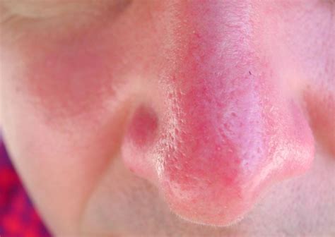 Prevention of a Sunburned Nose and How to Treat It - Skincarederm