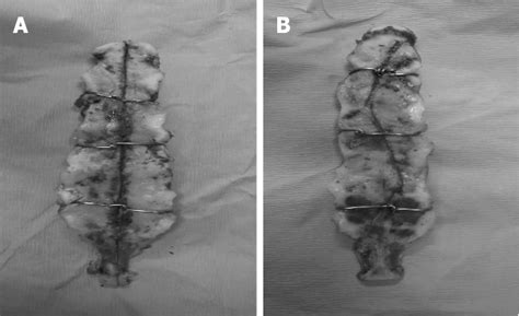 Figure 1 from Comparison of straight median sternotomy and interlocking ...