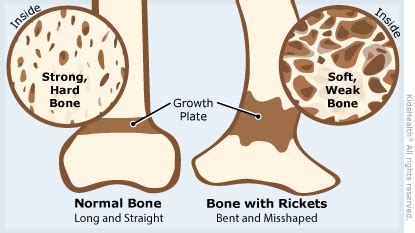 Rickets | Rady Children's Hospital