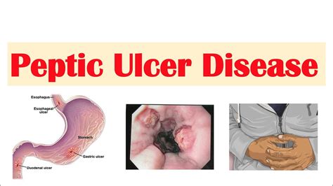 Peptic Ulcer Disease (Gastric vs. Duodenal Ulcers) | Causes, Symptoms ...