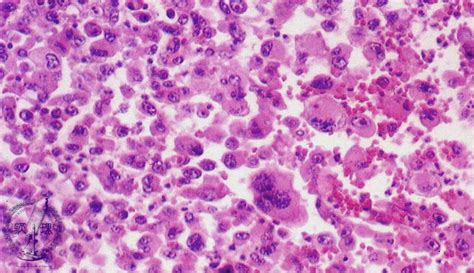 5.Lung, Pleura (17) Non-small cell lung carcinoma(large cell carcinoma)|Pathology Core Pictures