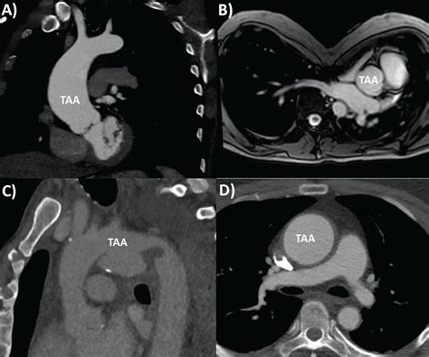 Thoracic aortic aneurysm: Optimal surveillance and treatment ...