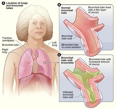 Rhonchi Lung Sound | Cause & Treatment - Lesson | Study.com