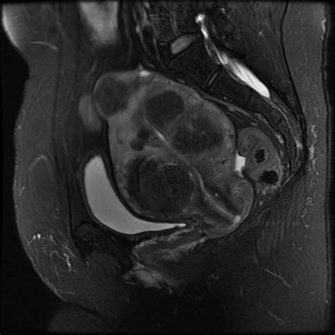 Fibroids | Body MRI