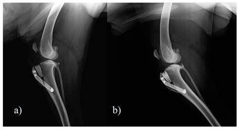 Tibial Tuberosity Fracture