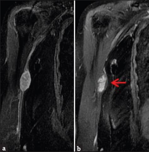 Magnetic Resonance Imaging Appearance of Schwannomas from Head to Toe: A Pictorial Review ...