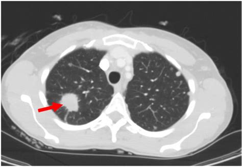 Figure 5. CT of the chest demonstrating a spiculated lung mass in the right upper lobe on axial ...