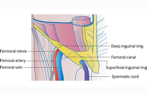 Diagnosing groin lumps | The BMJ