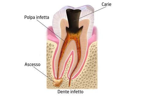 Ascesso dentale: cause, sintomi e rimedi - Studio Dentistico Cozzolino