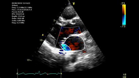 Normal Mitral Valve Echo