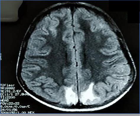 MRI T2 Flair image showing hyperintensities in bilateral occipital region. | Download Scientific ...