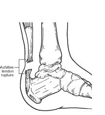 Achilles Tendon Rupture (Tear) - Dr. Barry Craythorne