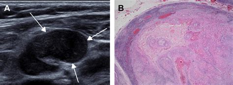 Ultrasonography of Cervical Lymph Nodes - Radiologic Clinics