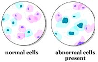 Abnormal Pap Smears -- Reading Your Results