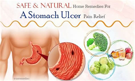 16 Safe Home Remedies For A Stomach Ulcer Pain Relief