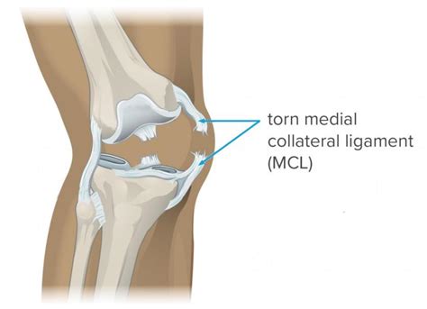 How Long Does An Mcl Tear Take To Heal