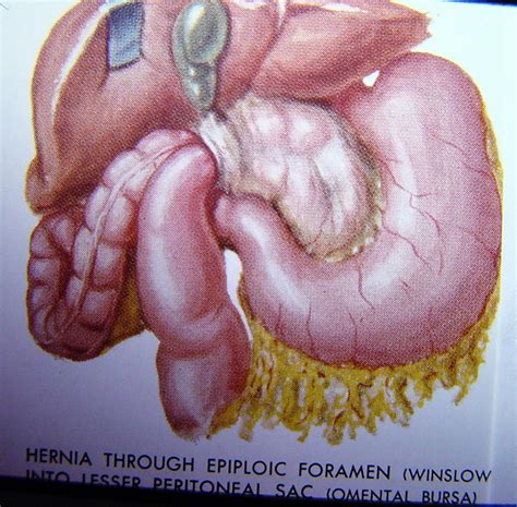 Hernia Internal 2617 Hernia Internal Foramen Of Winslow 6 | Surgery Photos