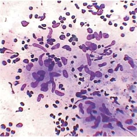 Microphotograph of FNAC lymph node smear showing Penicillium marneffei ...