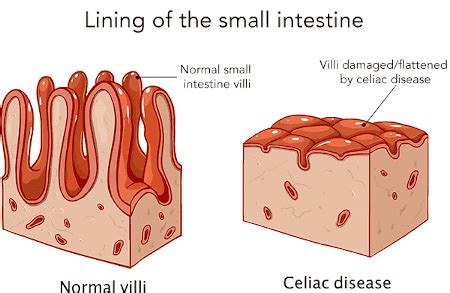 Celiac Disease: Symptoms, Testing, Treatment & Research