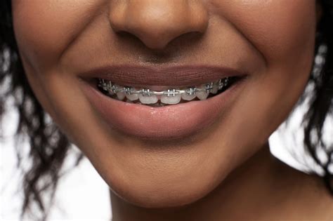 Premium Photo | Orthodontics concept Closeup of black womans smile with ...