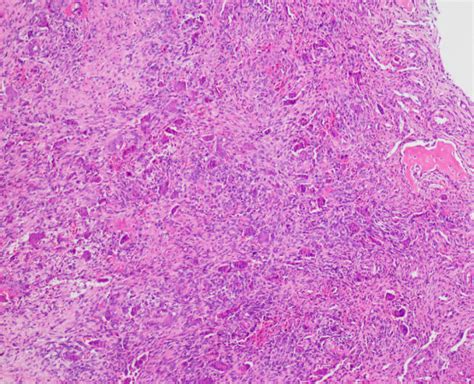 B. The histopathology of the areas of giant cell granuloma presented... | Download Scientific ...