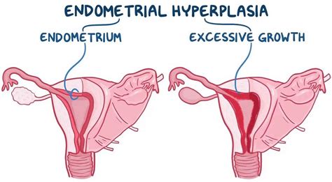 Endometrial hyperplasia, types, causes, symptoms, diagnosis, treatment ...