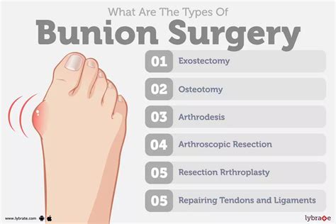 Bunion Surgery: Purpose, Procedure, Benefits and Side Effects