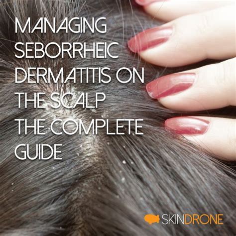 Seborrheic Dermatitis on the Scalp - The Complete Guide – SkinDrone