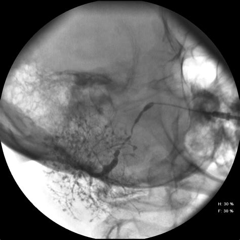 Sialogram Left Parotid Sjogrens Syndrome | Iowa Head and Neck Protocols