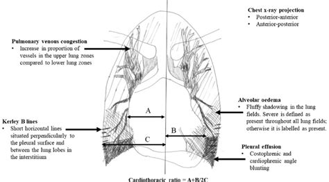 Illustration demonstrating how chest X-ray features of heart failure ...