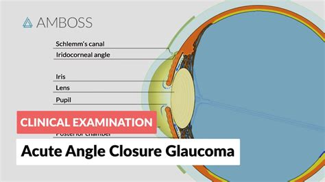 Closed Angle Glaucoma Vs Open Angle