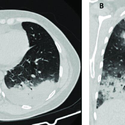 First chest CT scan shows the presence of consolidations with air... | Download Scientific Diagram