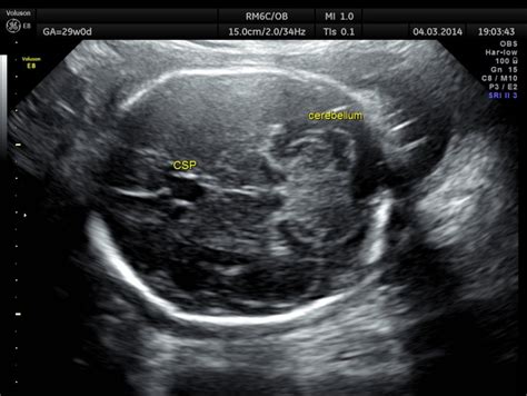 Choroid Plexus Cyst Ultrasound