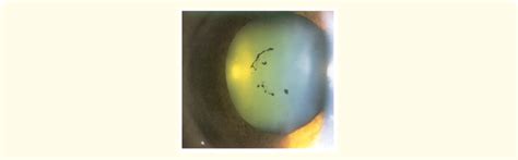 Broken synechiae over anterior lens capsule. | Download Scientific Diagram