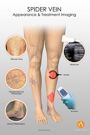 Spider Veins - What are they? - Alsara Vein Clinic