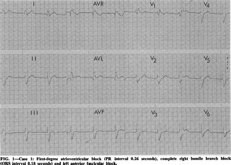 Figure 1 from Cardiac conduction abnormalities and Stokes-Adams attacks in myotonic dystrophy ...