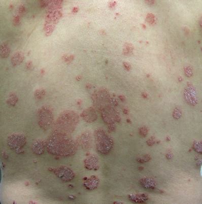 Erythematous truncal plaques- Clinical Advisor