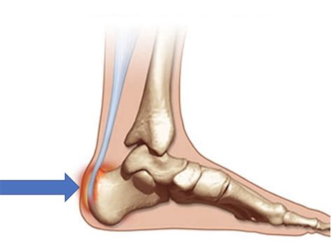 Retrocalcaneal Bursitis: Achilles Bursitis - Dr. Justin Dean