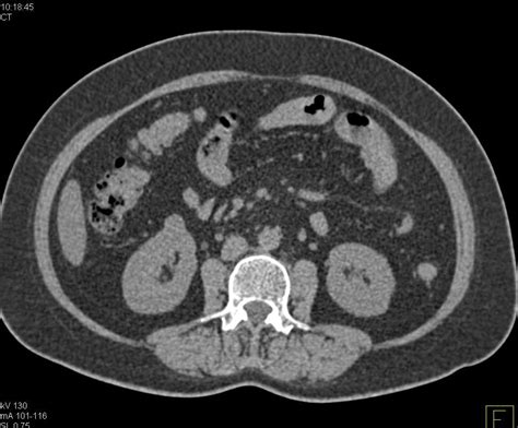 Renal Cell Carcinoma