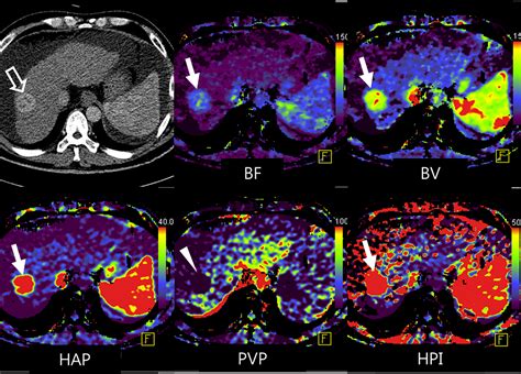 CT Perfusion of the Liver: Principles and Applications in Oncology | Radiology