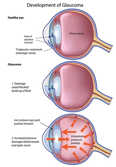 Laser Iridotomy for Glaucoma - Glaucoma Associates of Texas