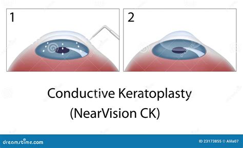 Conductive Keratoplasty Eye Surgery Royalty Free Stock Photo - Image: 23173855