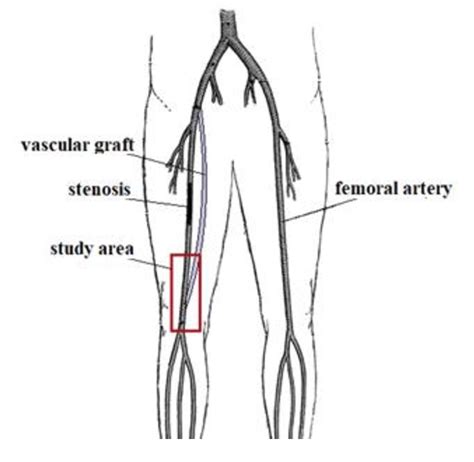 😝 Where is your femoral artery. What is femoral artery dissection?. 2022-12-08