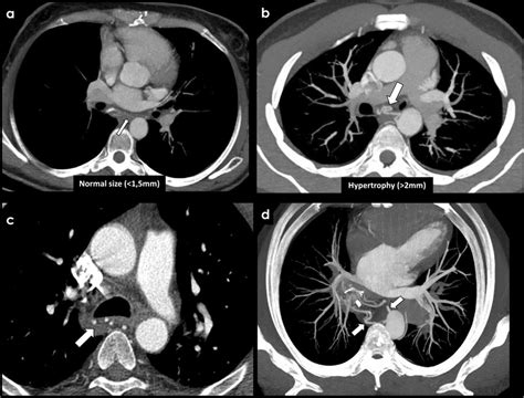 Imaging of the bronchial arteries. CECT findings of normal bronchial... | Download Scientific ...