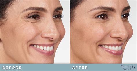 Botox Before and After Pictures | Cosmetic Dermatology Knoxville TN