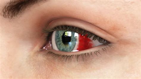 Subconjunctival Hemorrhage - First Eye Care Irving